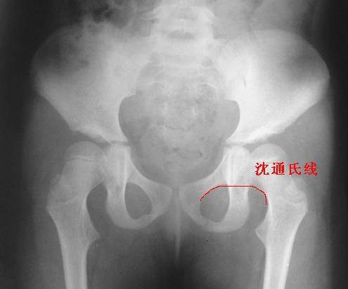 沈通氏线