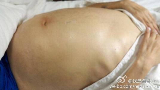 肠胀气