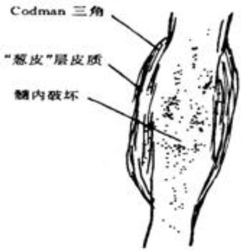 Codman三角