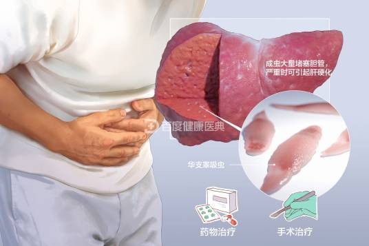 华支睾吸虫病