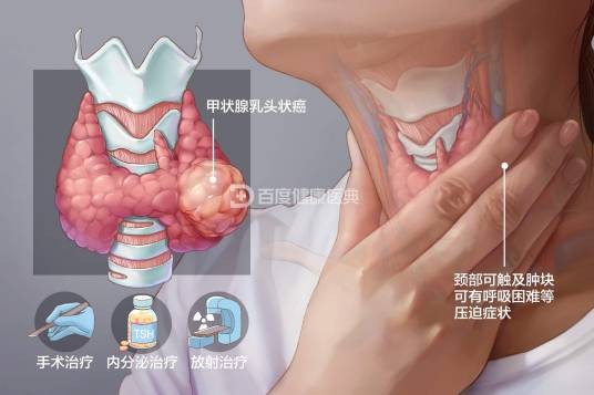 甲状腺乳头状癌