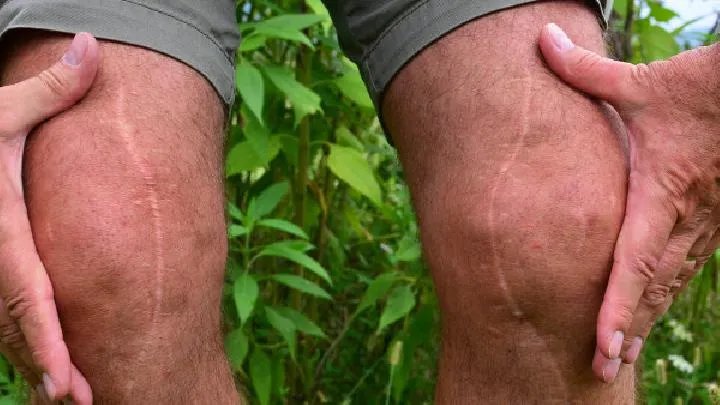 疤痕植发的特点及优势