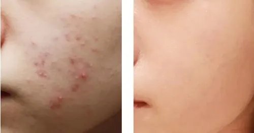 做激光治疗痤疮的费用是多少