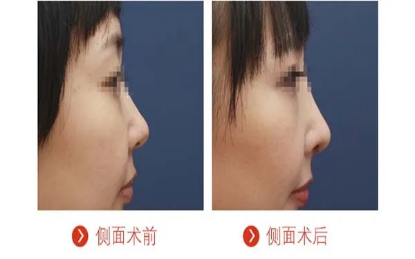 北京隆鼻哪些医院比较好?