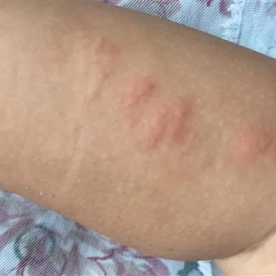 肤蝇蛆怎么治疗
