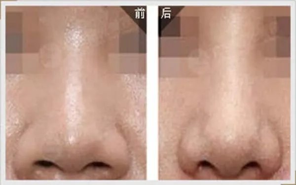 北京隆鼻哪些医院比较好?