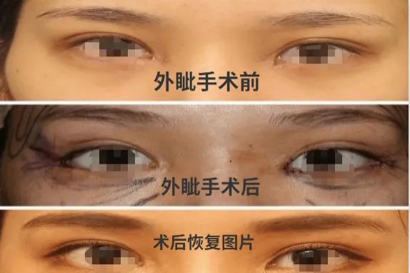 开眼角照片