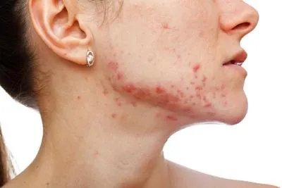 针灸能治疗痤疮吗 如何针灸治疗痤疮