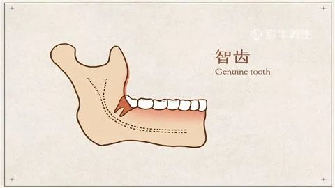 长了智齿一定要拔吗