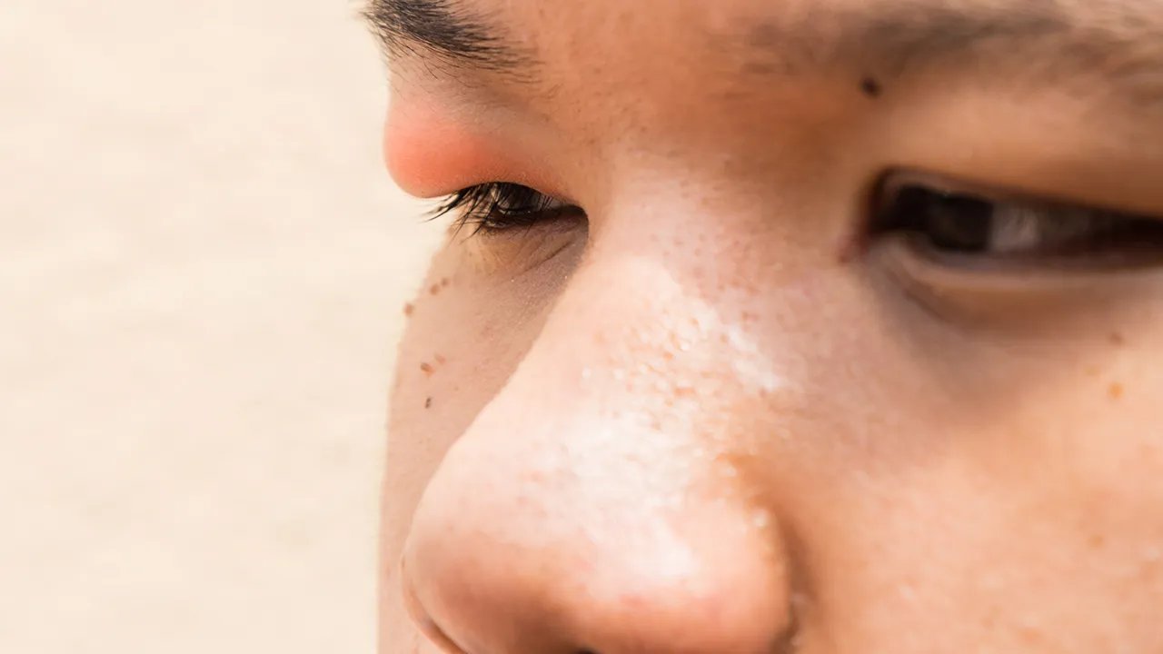 红眼病的症状和治疗