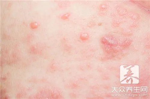身上起了好多红疙瘩很痒怎么办