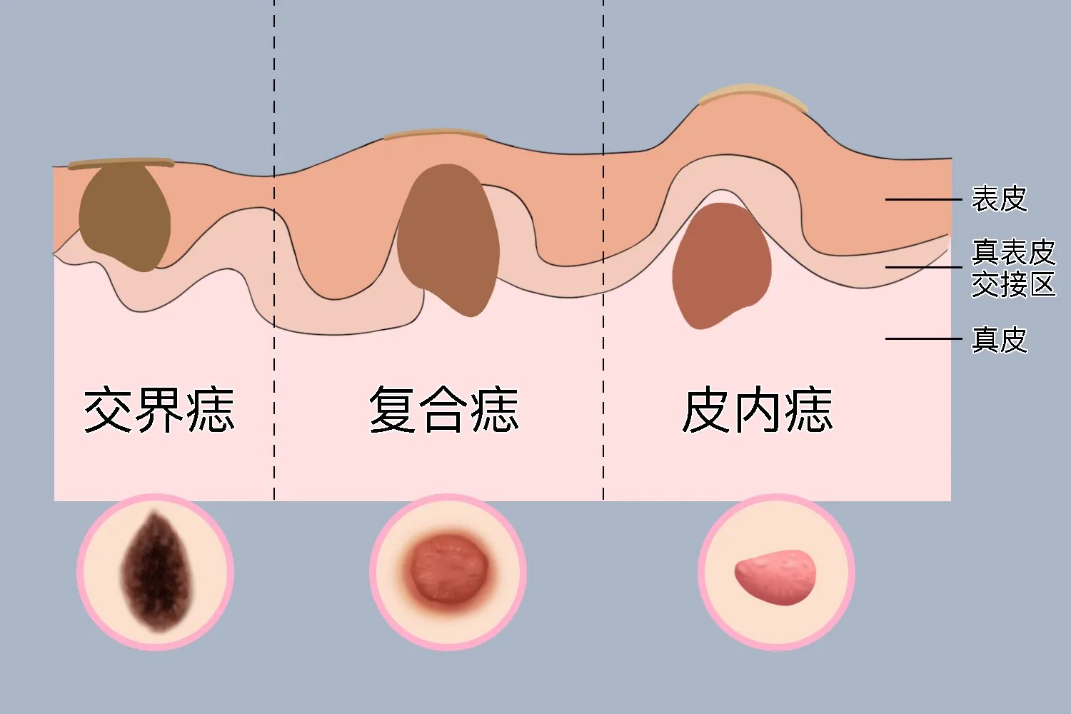痣的图片