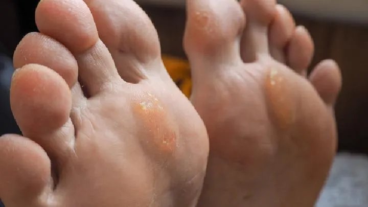 鸡眼应该怎样根治