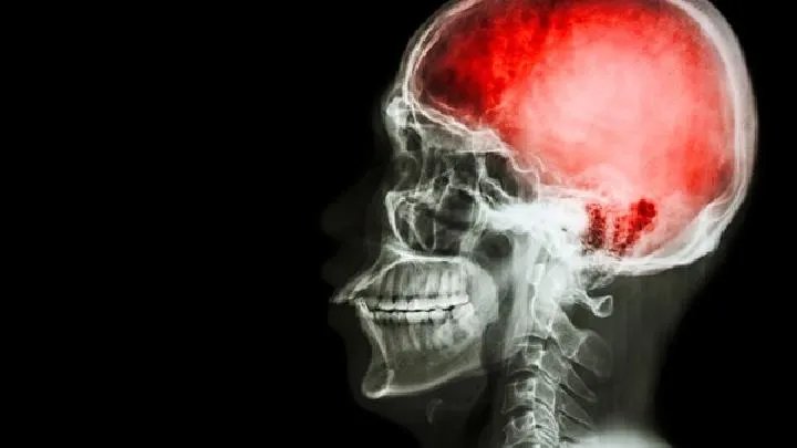 专家分析大脑萎缩临床表现