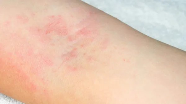 中药治疗皮肤过敏的方法