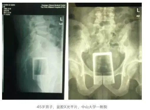 别往菊花和丁丁里塞奇怪的东西了，取出来的时候很疼的！