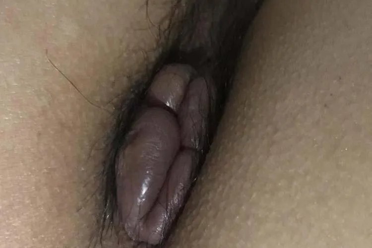 女性外痔疮图片