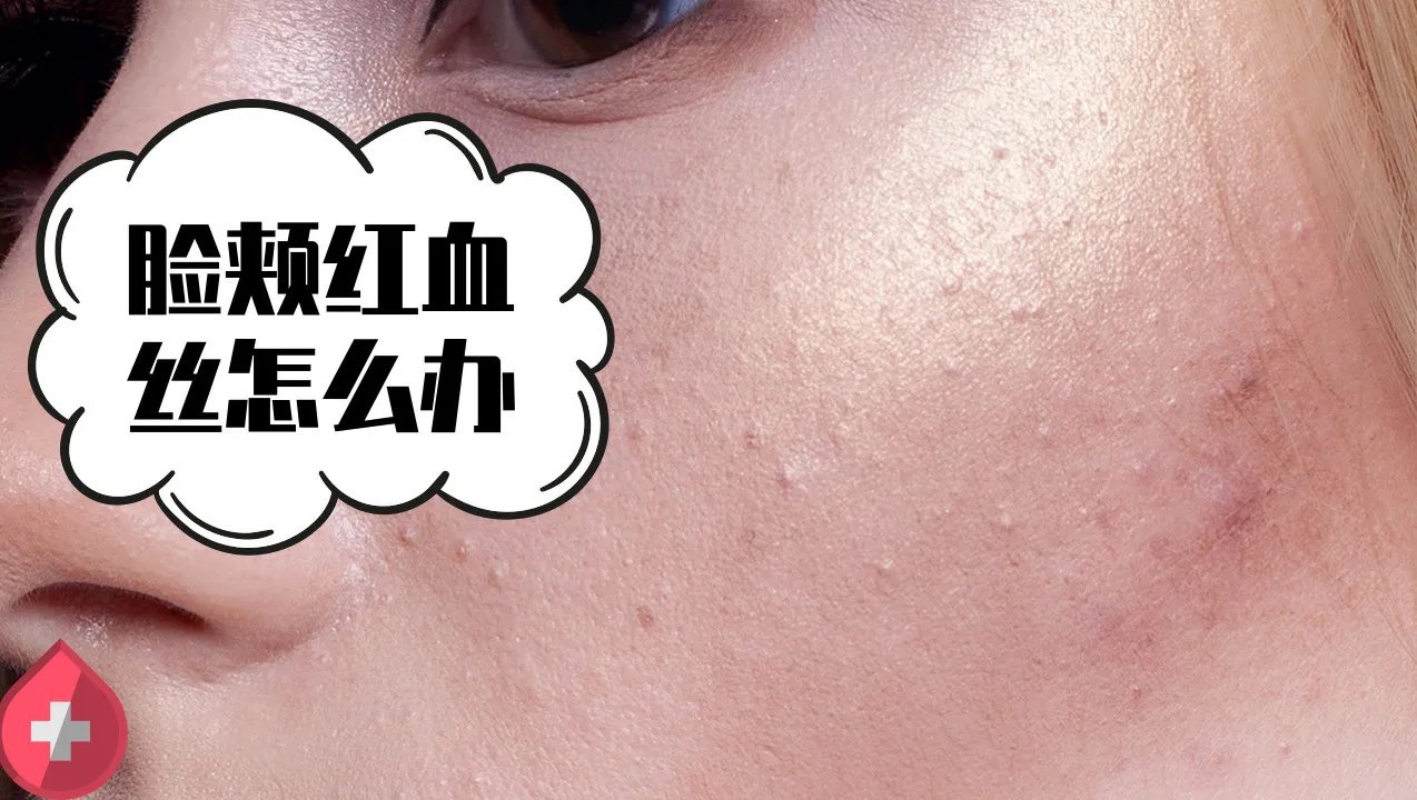 脸颊红血丝怎么办