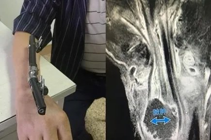 被虾刺中险被截肢:是怎么回事,小小海虾引起风波真相