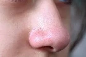 整形鼻子款式图片
