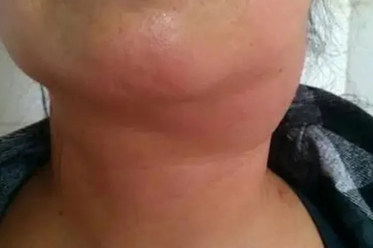 血癌的早期症状是什么样
