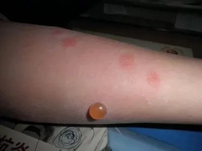 蚋叮咬引起的皮肤反应大水疱图片