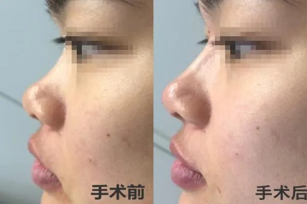 玻尿酸隆鼻效果图对比