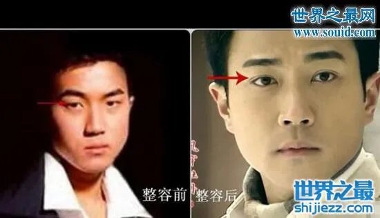 刘恺威整容前后照片曝光,五官全整简直大换脸