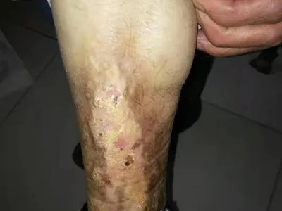 慢性湿疹小腿症状图片