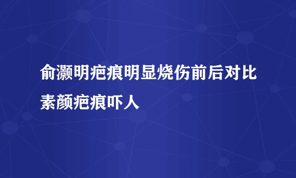俞灏明疤痕明显烧伤前后对比素颜疤痕吓人