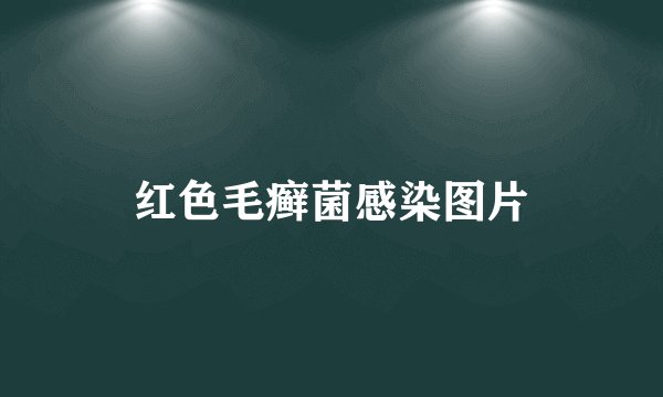 红色毛癣菌感染图片