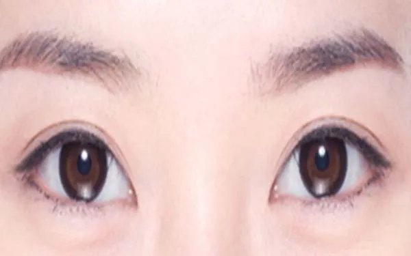 北京双眼皮去哪家医院好?