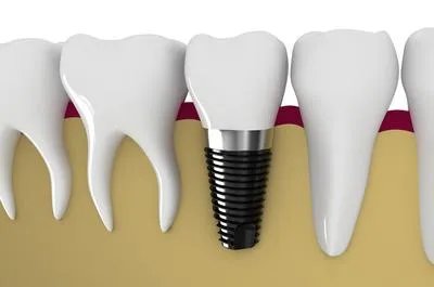 怎么做种植牙 了解做种植牙的步骤