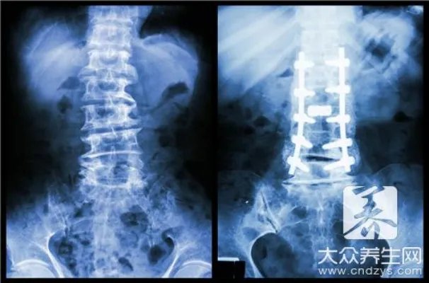运动神经元萎缩伴有那些表现？