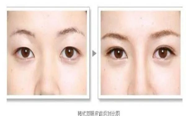 北京好的眼部手术整形医院在哪？