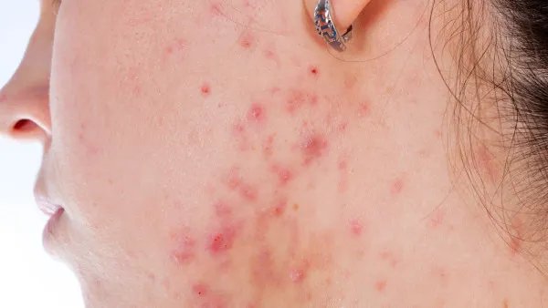 激光去痘印需要几个疗程