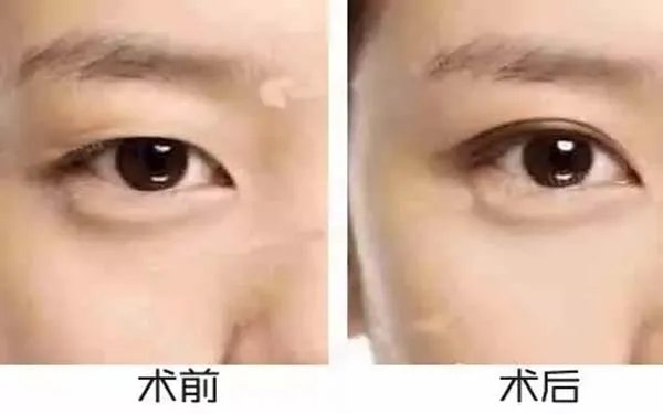 北京好的眼部手术整形医院在哪？