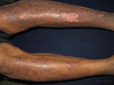 慢性湿疹小腿症状图片