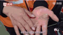 单腿小哥送外卖是什么情况:一条腿和一副拐杖送餐及时