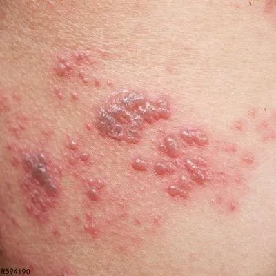 治疗疱疹的方法盘点 介绍治疱疹的三种方法