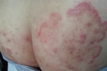 宝宝股癣图片