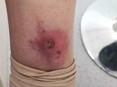 丹毒症状图片