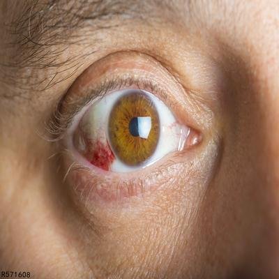 红眼病有哪些症状 揭秘红眼病的6种症状
