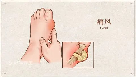 痛风怎么治疗最有效的方法