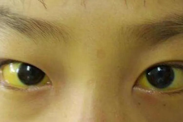 拔毛癖严重后果是什么样的