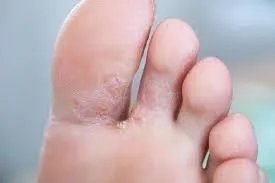 脚上皮肤病大全图