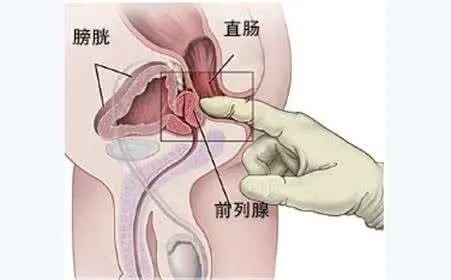 慢性前列腺症状有哪些?
