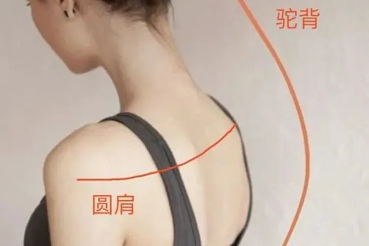 轻微驼背图片