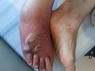 丹毒症状图片