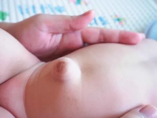 婴儿脐疝怎么回事